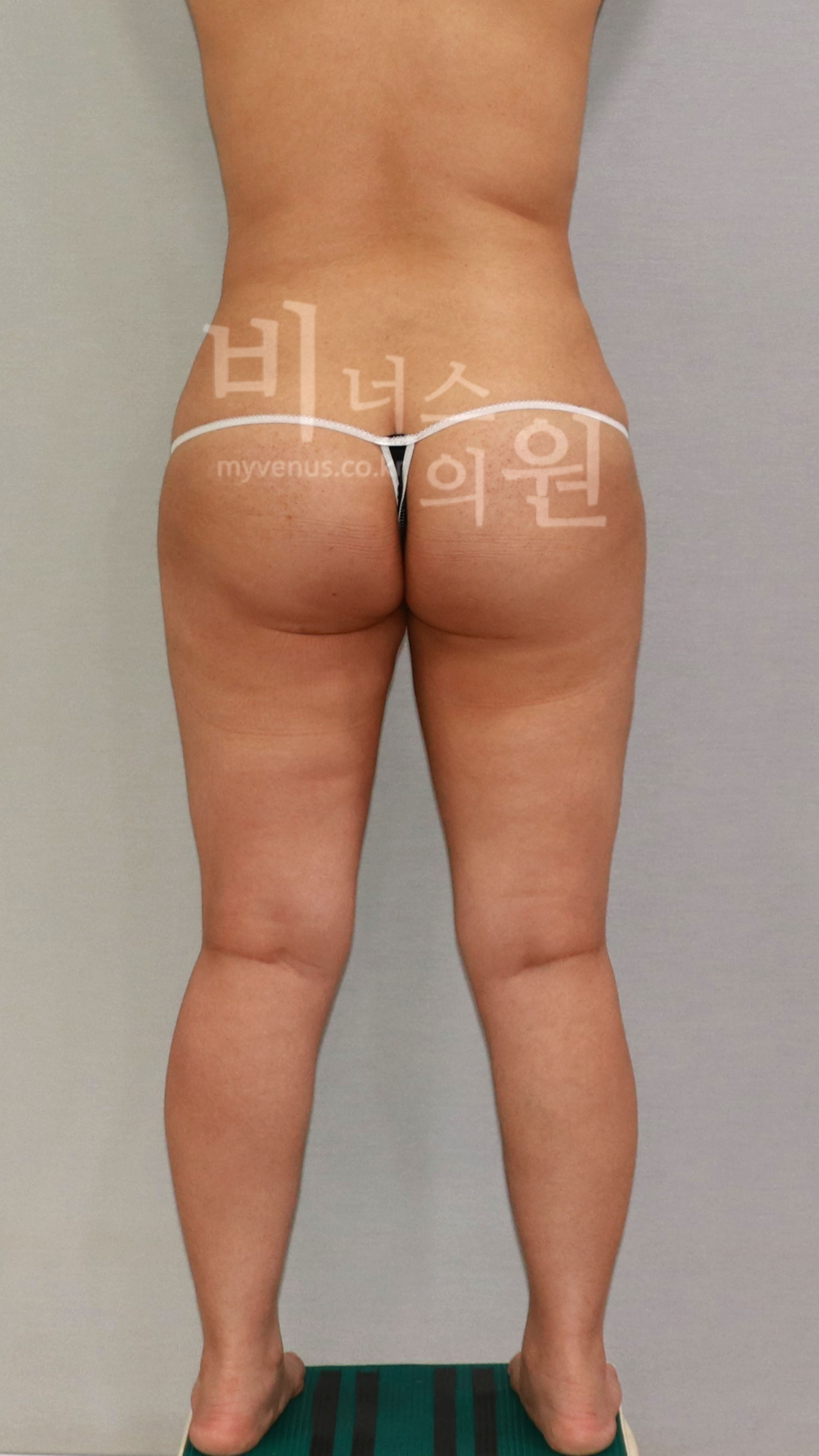 수술 전 — 후면 · 다리 벌림