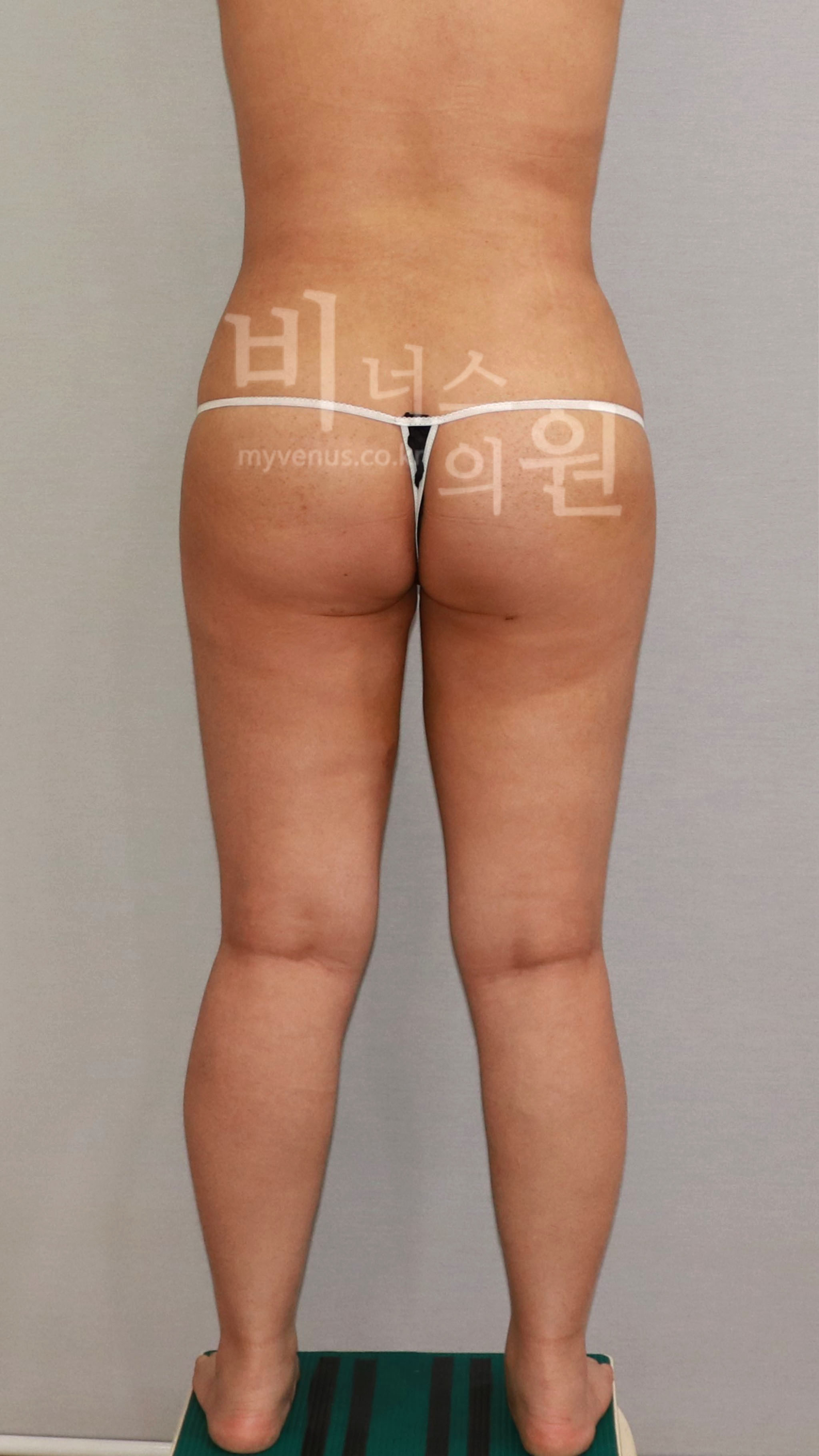 수술 후 — 후면 · 다리 벌림