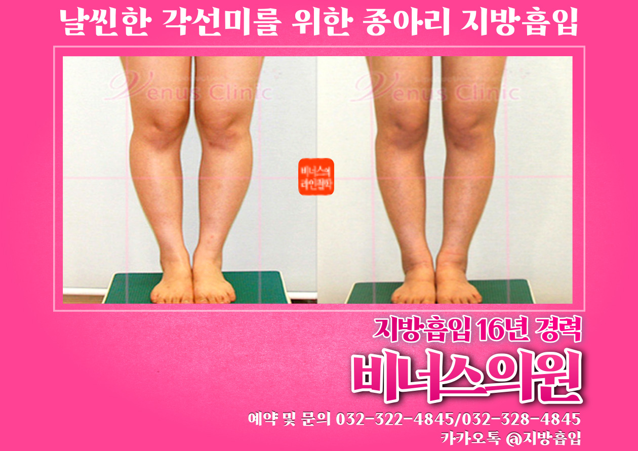 종아리지방흡입-003 (2).jpg