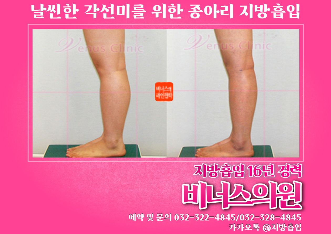 종아리지방흡입-003 (4).jpg