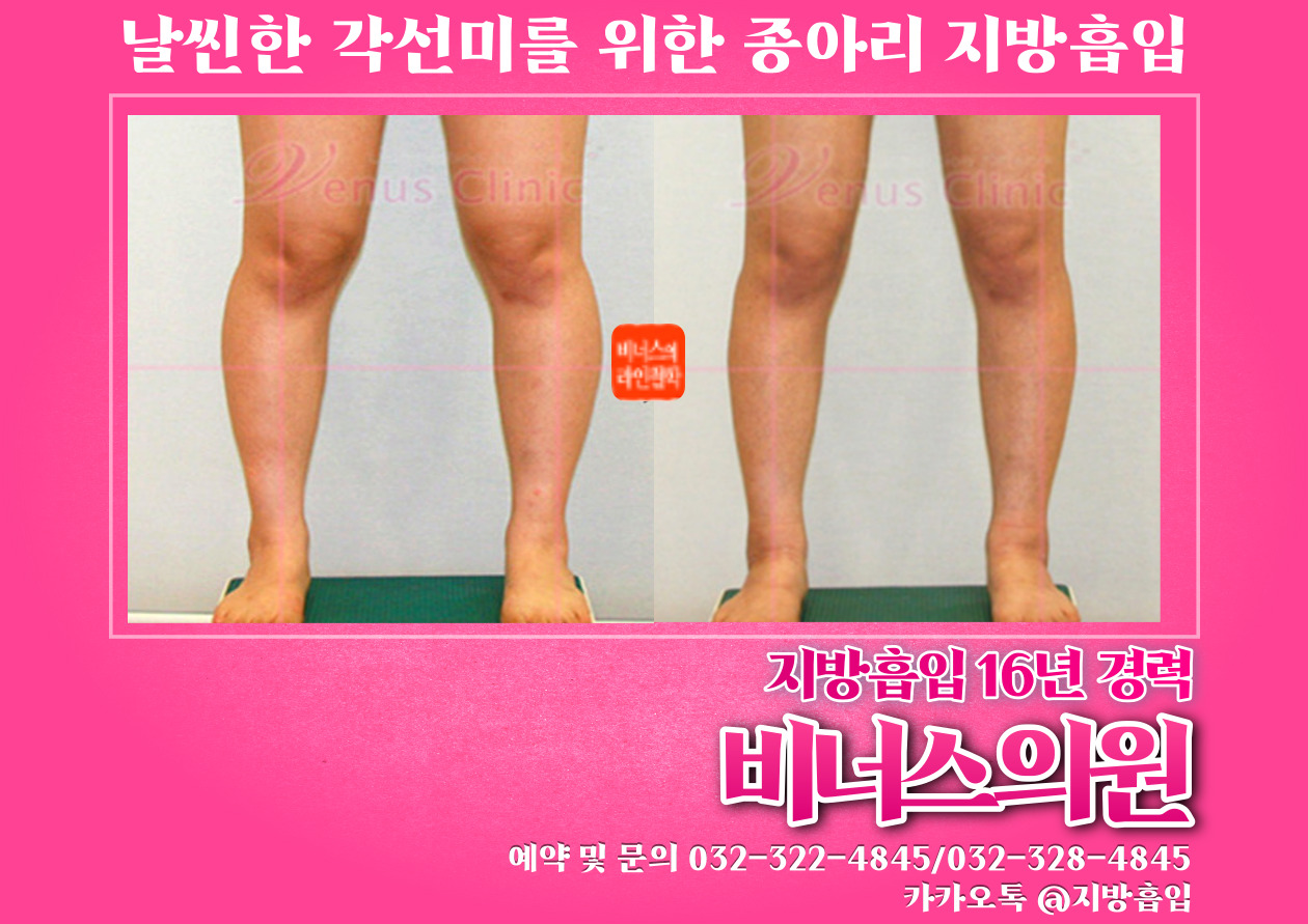 종아리지방흡입-003 (3).jpg