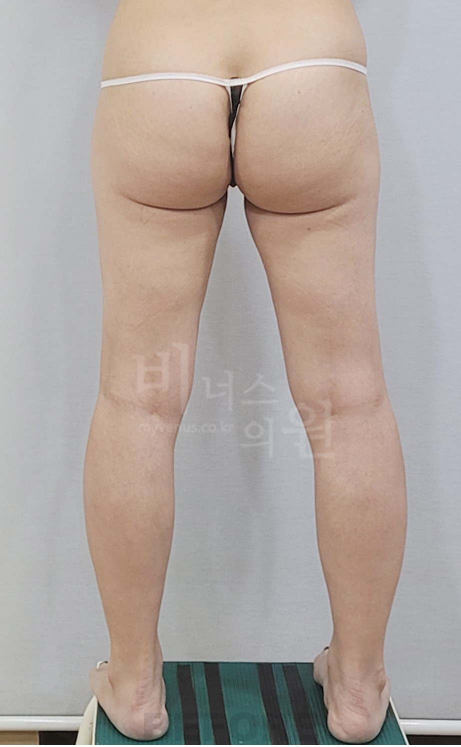 엉덩이축소 지방흡입 수술 전 다리를 벌린 후면 비너스의원