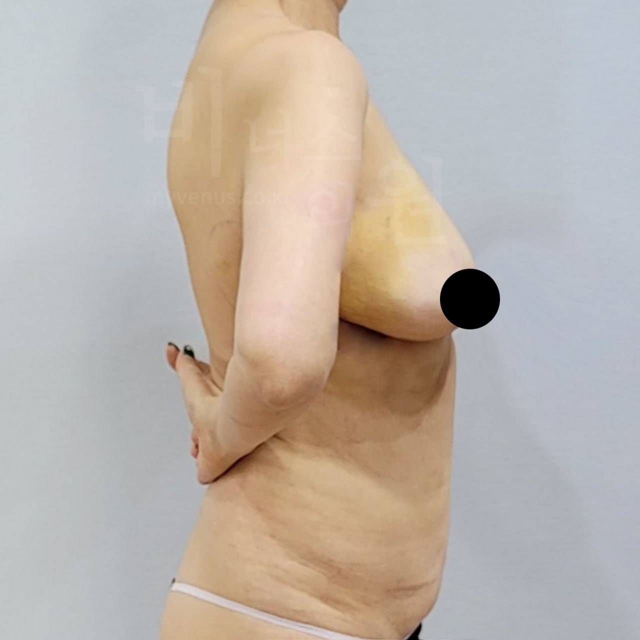 가슴축소 지방흡입 수술 후 왼측