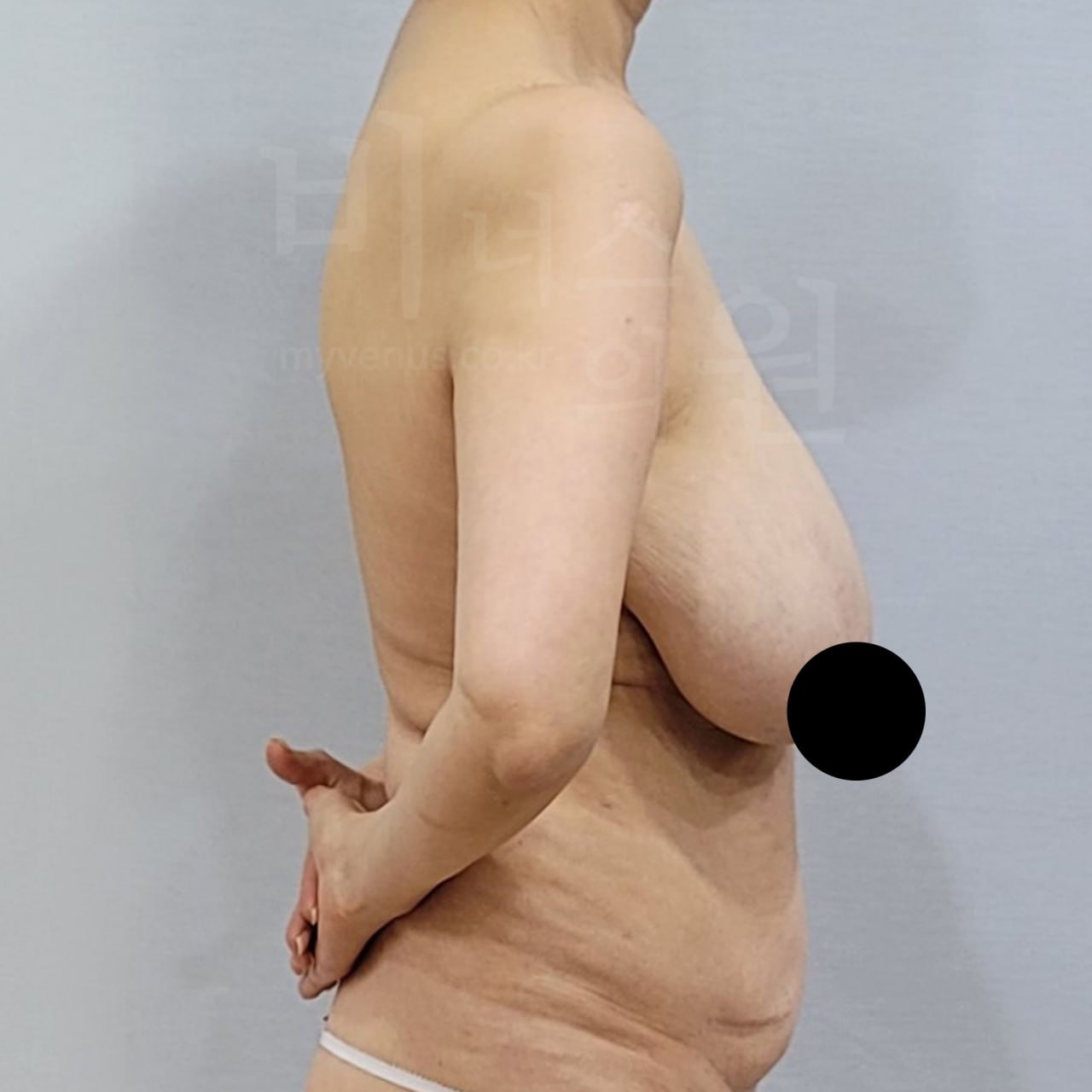 가슴축소 지방흡입 수술 전 왼측