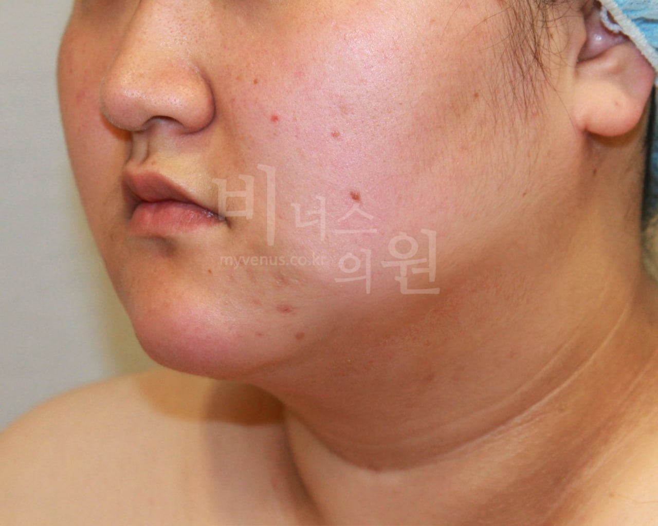 턱지방흡입 후 45도 비너스의원