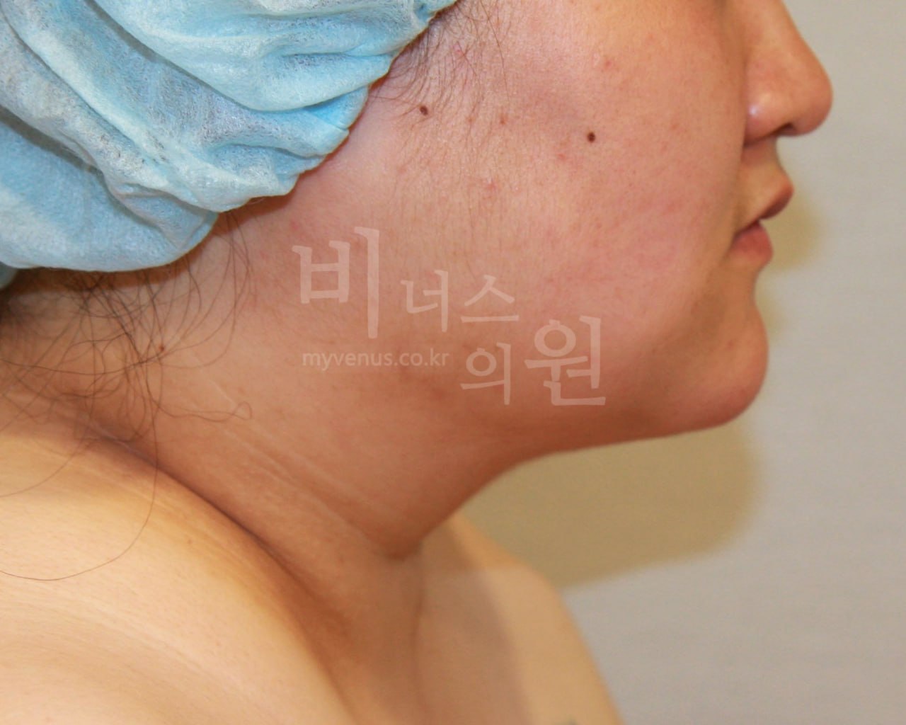 턱지방흡입 후 측면 비너스의원