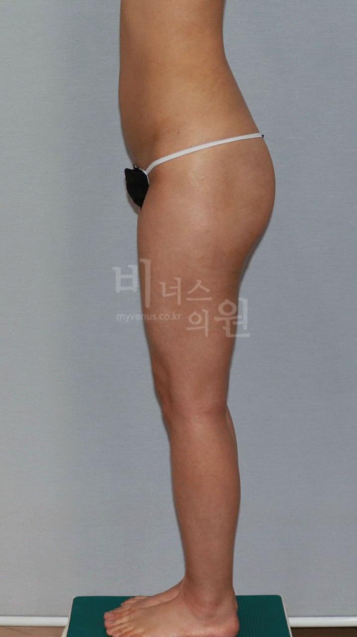 엉덩이 지방흡입 수술 후 측면