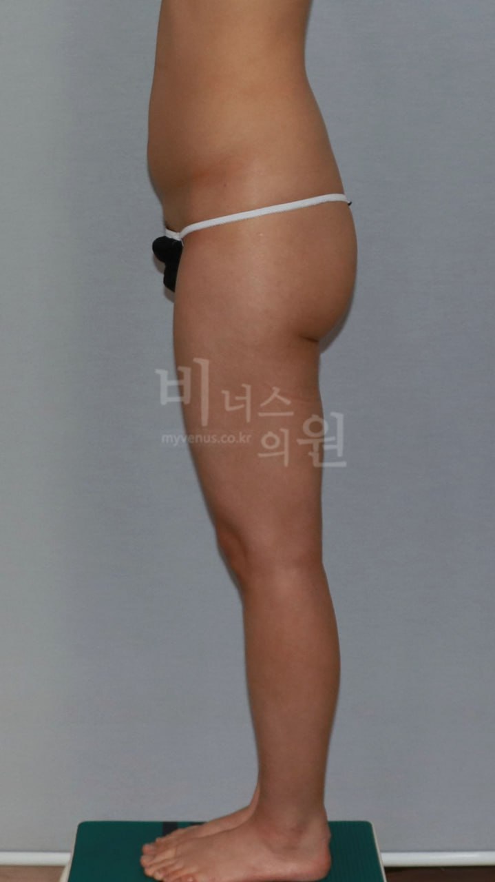 엉덩이 지방흡입 수술 전 측면