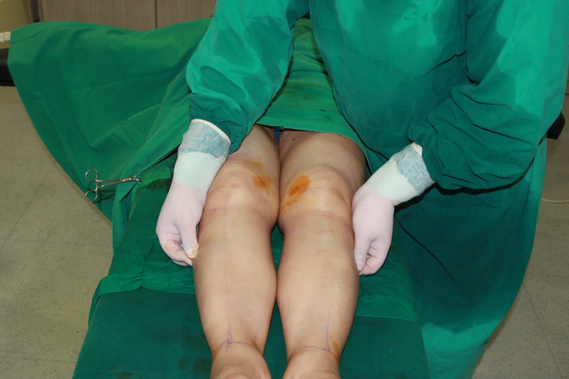 종아리지방흡입 종아리지방흡입부작용 종아리지방흡입부작용 종아리지방흡입스킨테스트 종아리지방흡입회복기간 종아리지방흡입효과 종아리수술전후후기 종아리지방흡입경과 종아리지방흡입붓기 발목지방흡입 무릎지방흡입 종아리 알 종아리부종빼는법 종아리근육주사 종아리보톡스.JPG