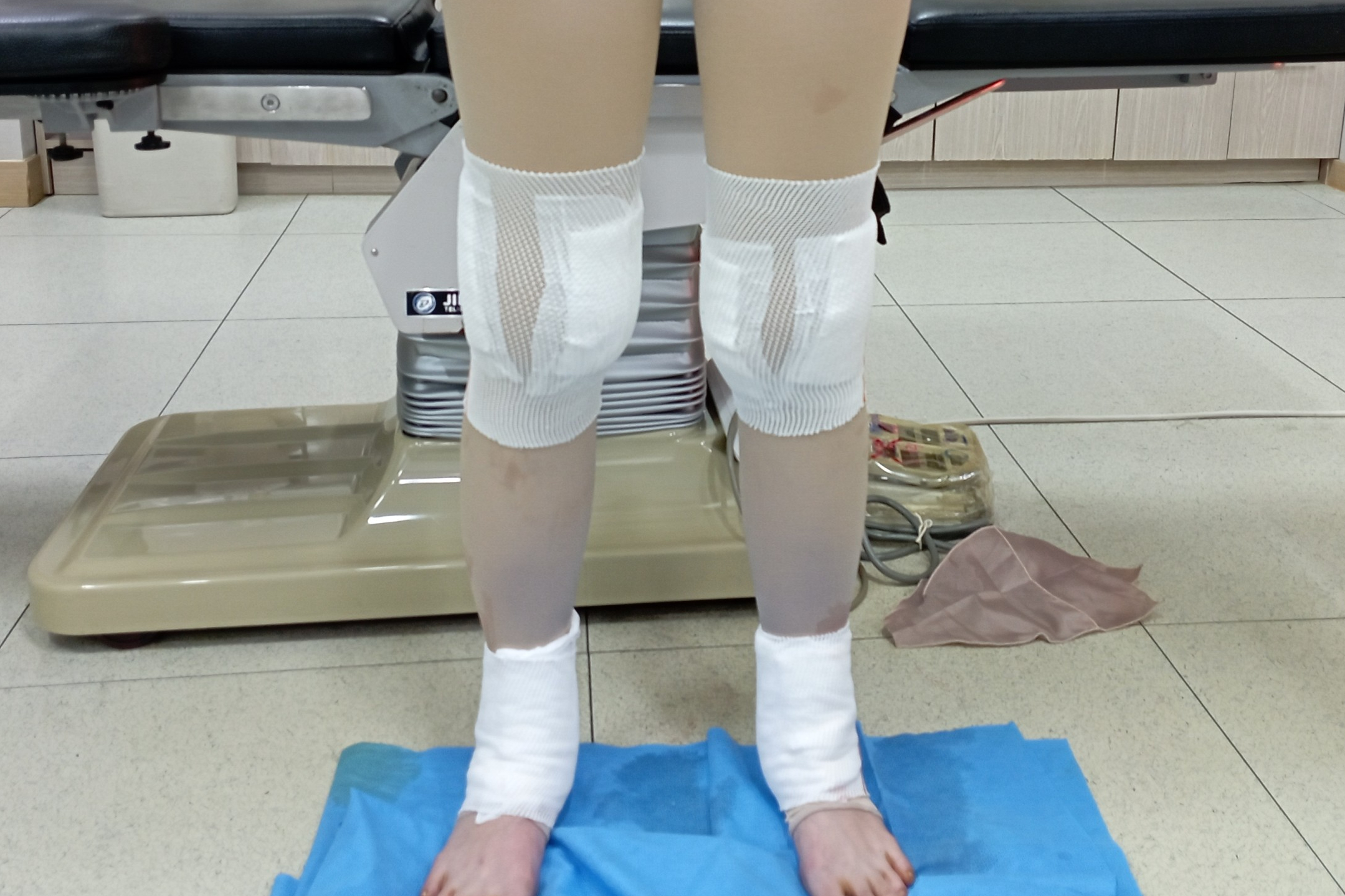 종아리지방흡입 종아리지방흡입부작용 종아리지방흡입부작용 종아리지방흡입스킨테스트 종아리지방흡입회복기간 종아리지방흡입효과 종아리수술전후후기 종아리지방흡입경과 종아리지방흡입붓기 발목지방흡입 무릎지방흡입 종아리 알 종아리부종빼는법 종아리근육주사 종아리보톡스 종아리지방흡입붓기.jpg