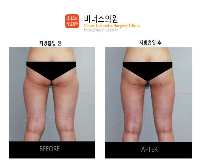 허벅지지방흡입 (4).jpg