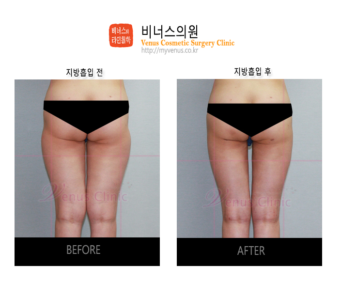 허벅지지방흡입 (9).jpg