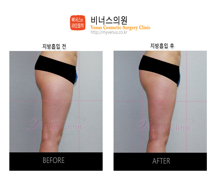 허벅지지방흡입 (8).jpg