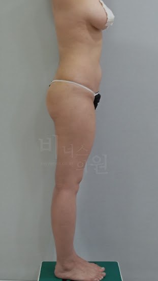 엉덩이 볼륨업 지방흡입 수술 후 우측면 비너스의원