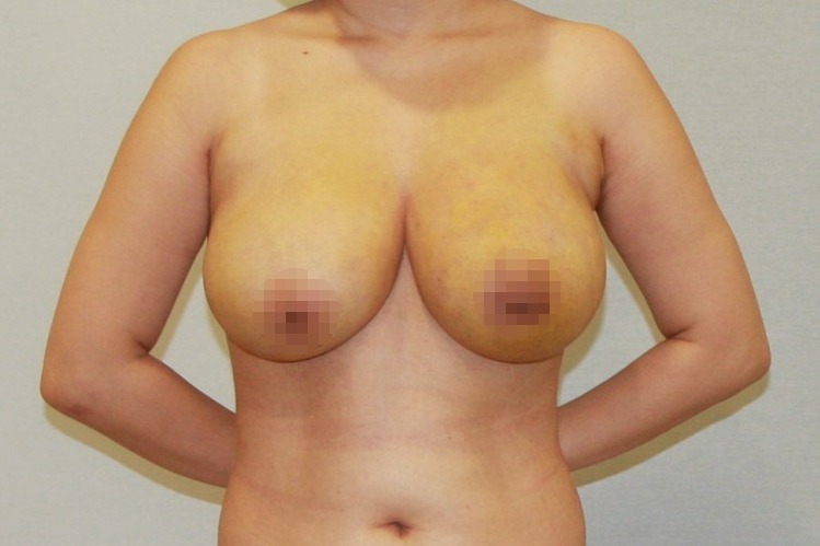 유방축소지방흡입 가슴축소지방흡입 젖꼭지하수 젖꼭지교정 처진가슴 늘어진가슴 유방하수 거대유방 유방지방흡입 가슴지방흡입 유방축소 가슴축소 수술후관리 흉터 멍 부기 1주 4주 경과 후기.jpg