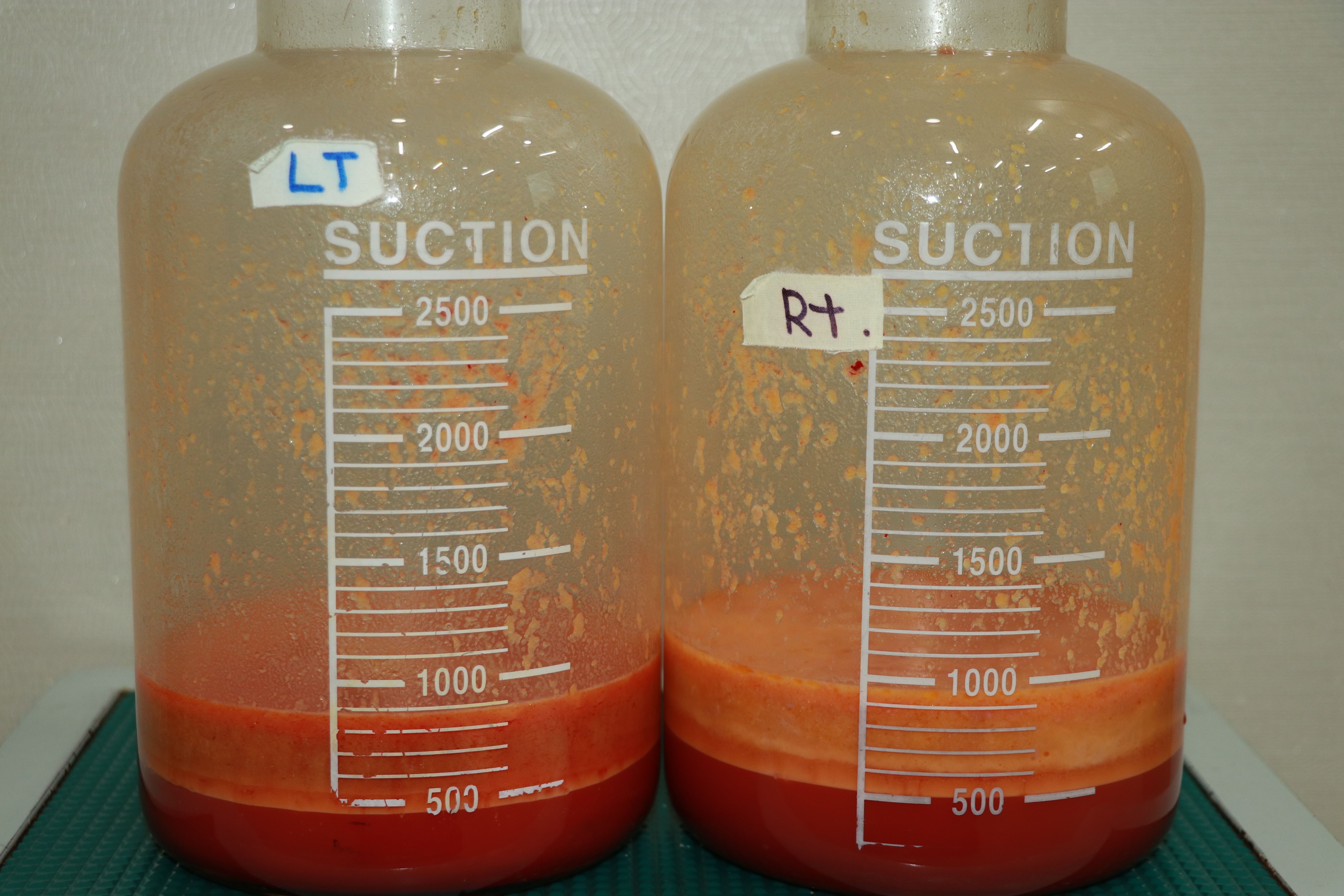 유방축소지방흡입 가슴축소지방흡입 젖꼭지하수 젖꼭지교정 처진가슴 늘어진가슴 유방하수 거대유방 유방지방흡입 가슴지방흡입 유방축소 가슴축소 수술후관리 흉터 멍 부기 1주 4주 경과 지방량 후기.jpg