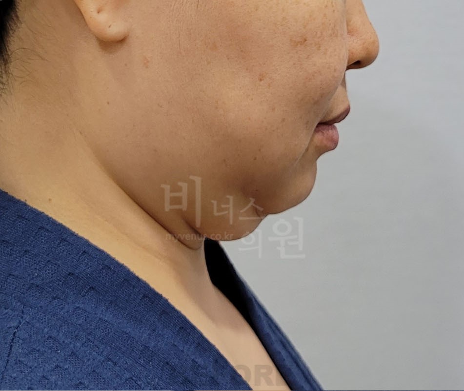 턱 지방흡입 수술 전 반대쪽 측면 비너스의원