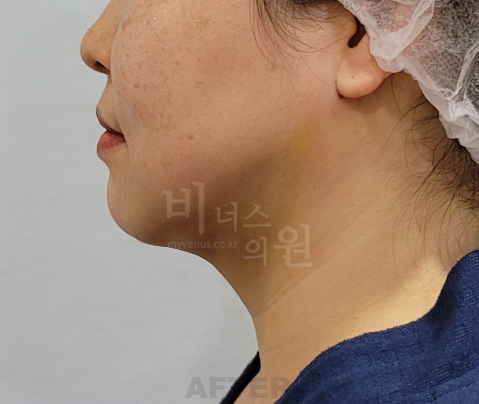 턱 지방흡입 수술 후 측면 비너스의원