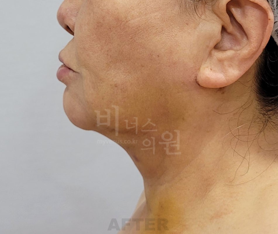 턱 지방흡입 수술 후 측면 비너스의원