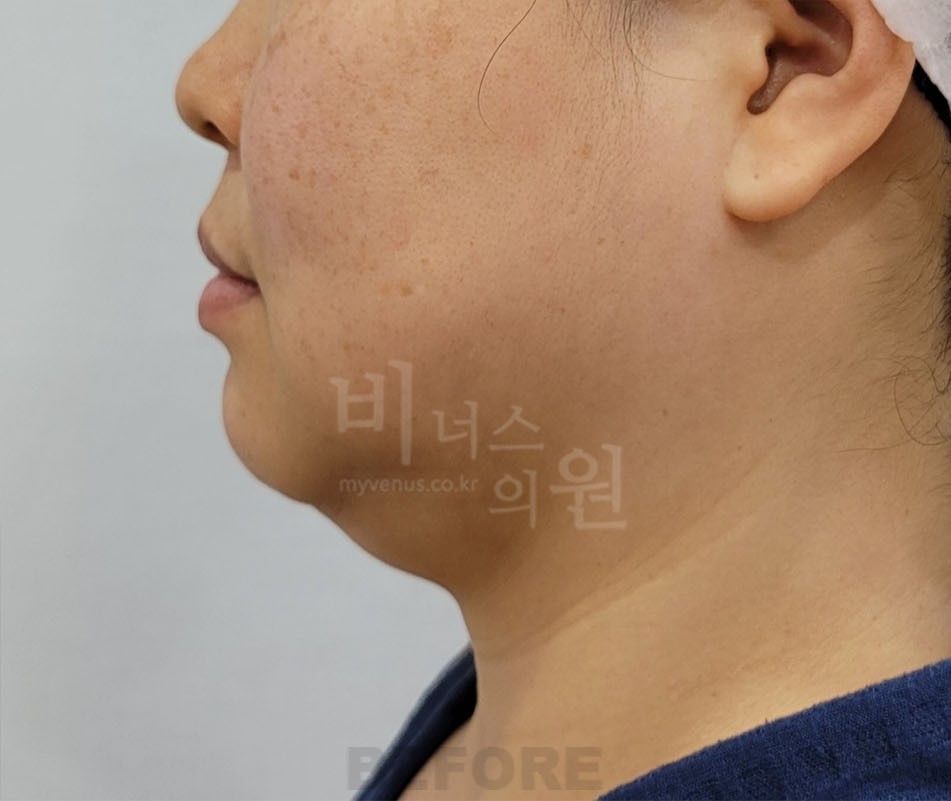 턱 지방흡입 수술 전 측면 비너스의원
