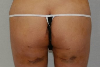 엉덩이 주름 힙업 지방흡입 지방이식.jpg