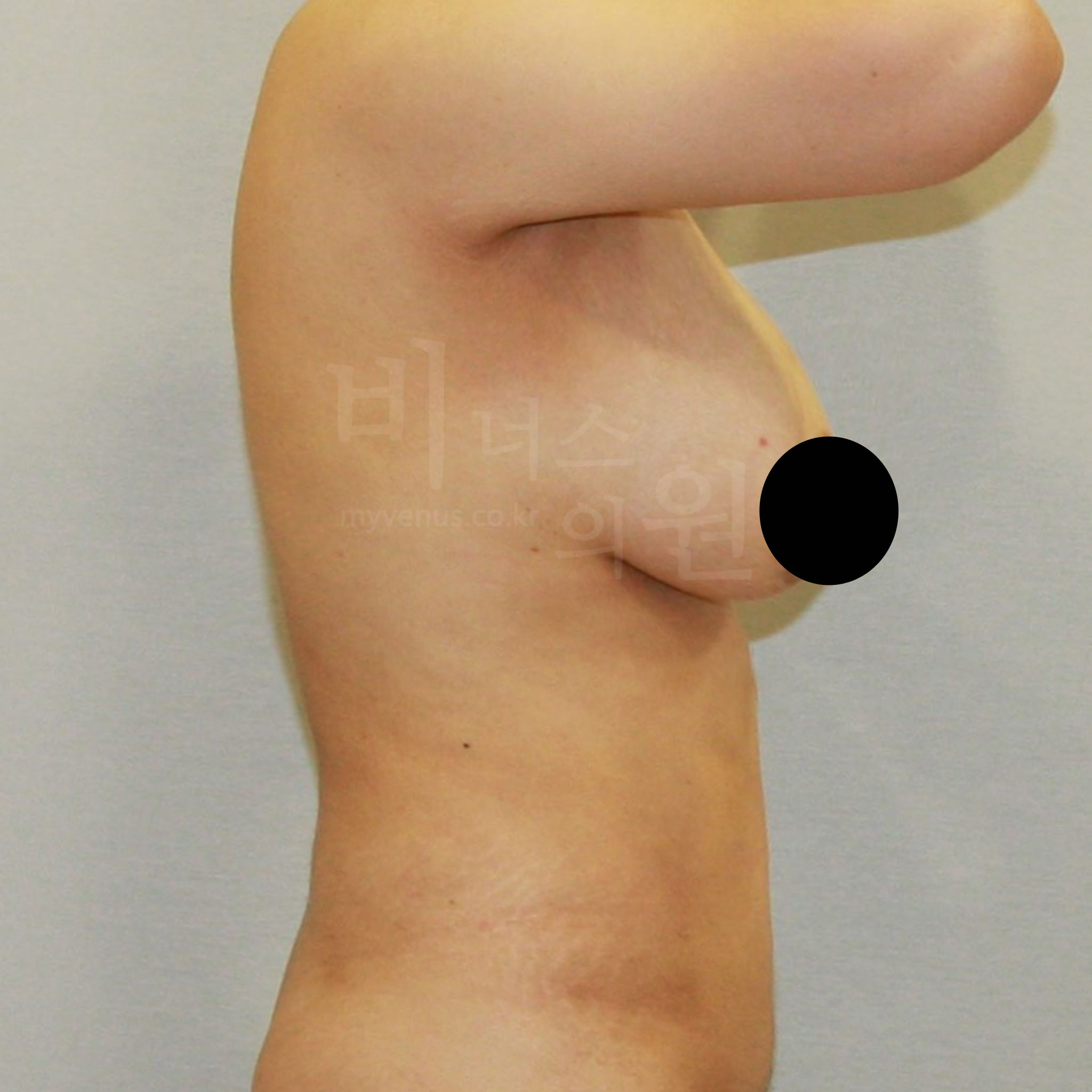 가슴축소 지방흡입 수술 전 측면 — 비너스의원 CASE1