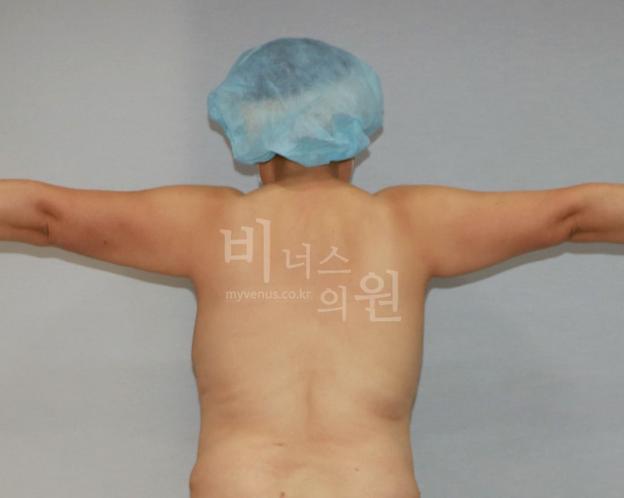 팔뚝 지방흡입 전후사진 후면 T자 수술전 비너스의원