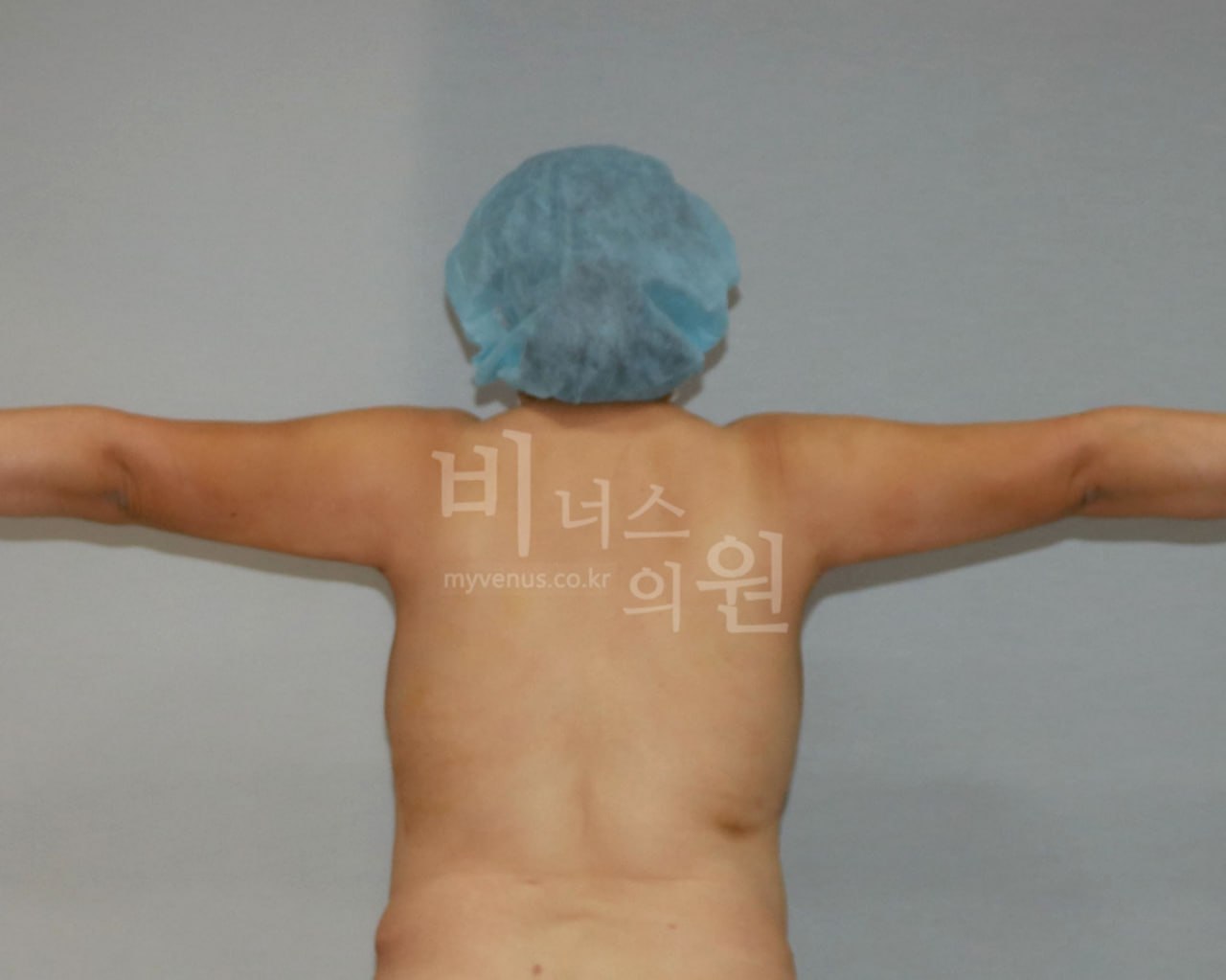 팔뚝 지방흡입 전후사진 후면 T자 수술후 비너스의원