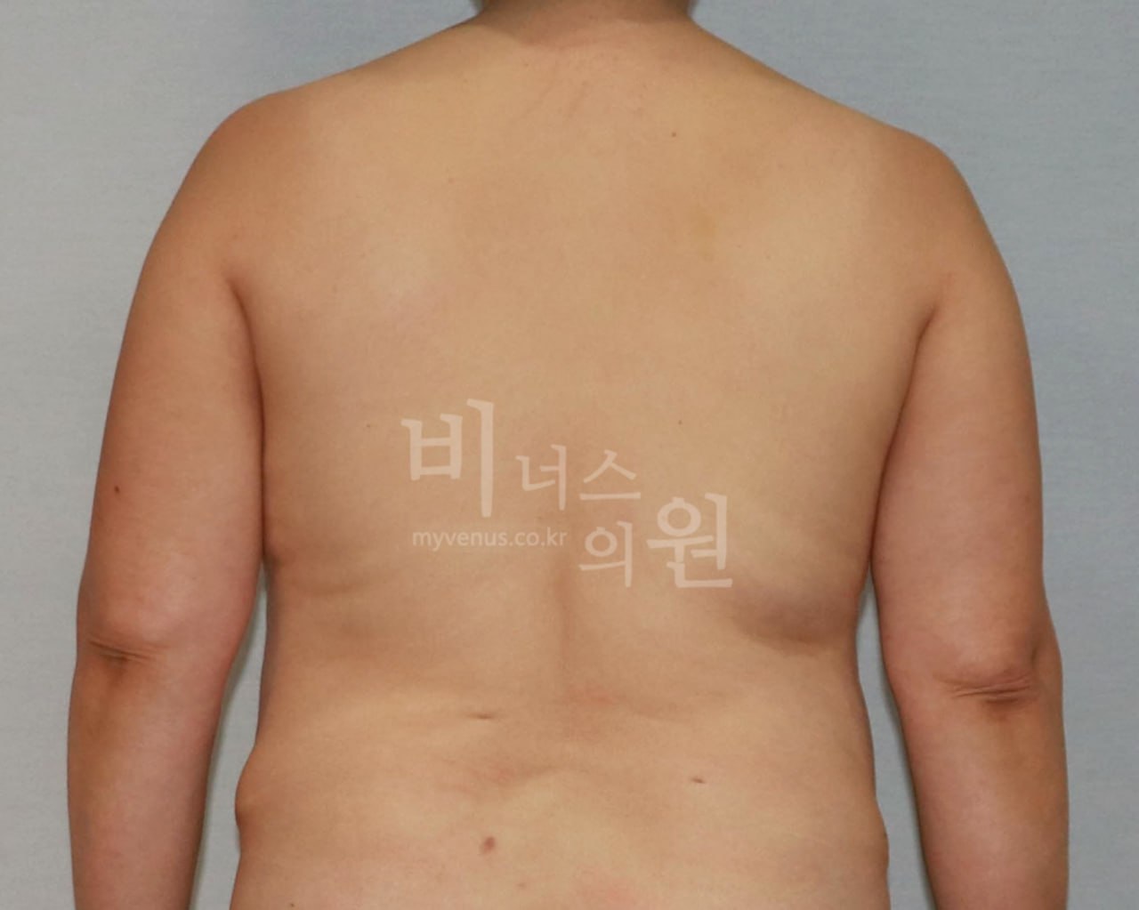 팔뚝 지방흡입 전후사진 후면 팔내림 수술전 비너스의원