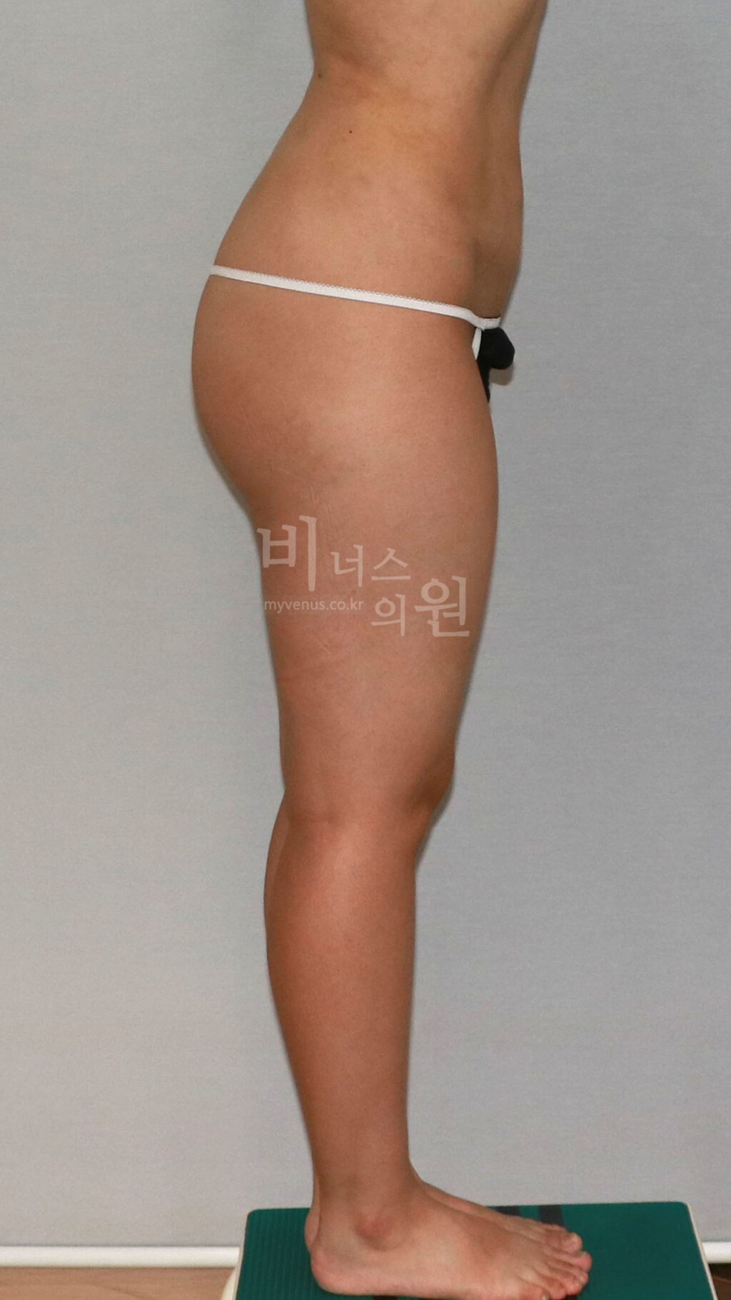 허벅지 지방흡입 수술 전 측면 비너스의원
