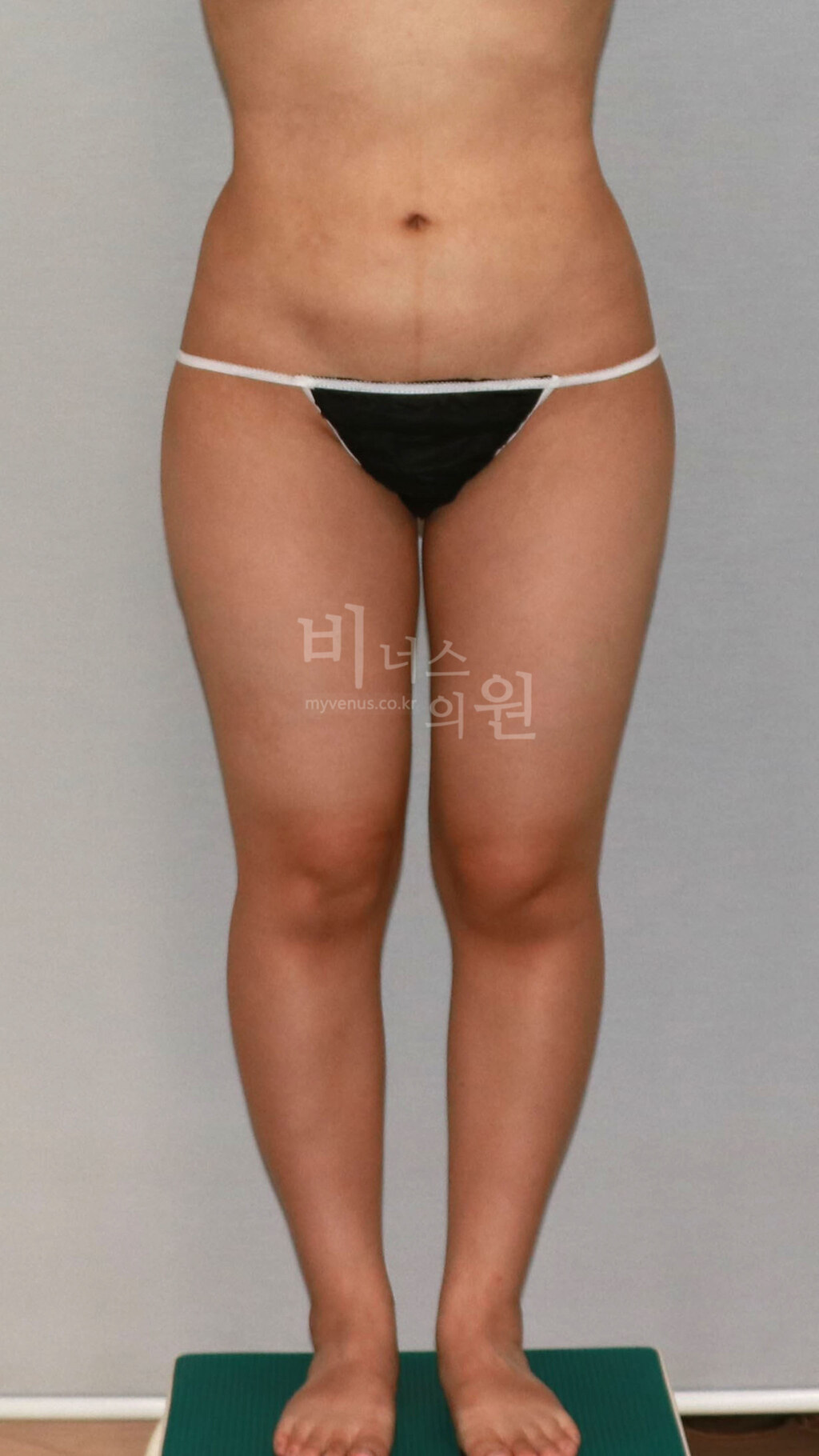 허벅지 지방흡입 수술 전 정면 비너스의원