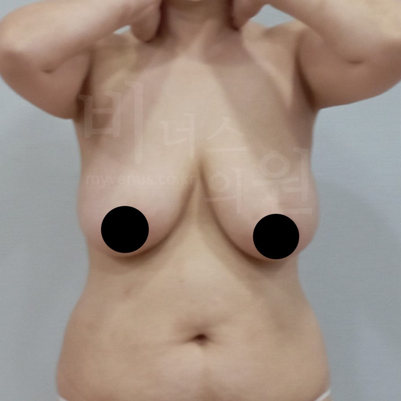 가슴 지방흡입 수술 전 정면