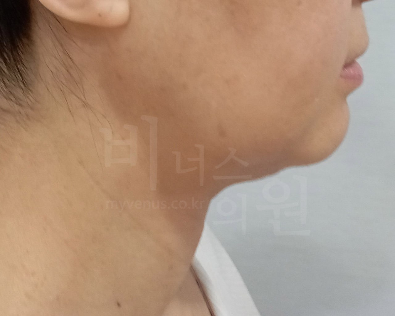 턱지방흡입 수술 전 왼측면 비너스의원