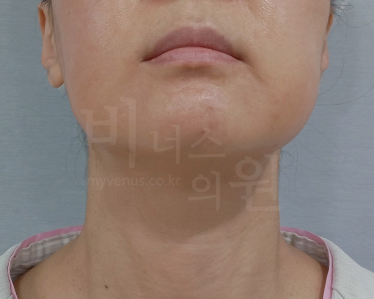 턱지방흡입 수술 전 정면 비너스의원