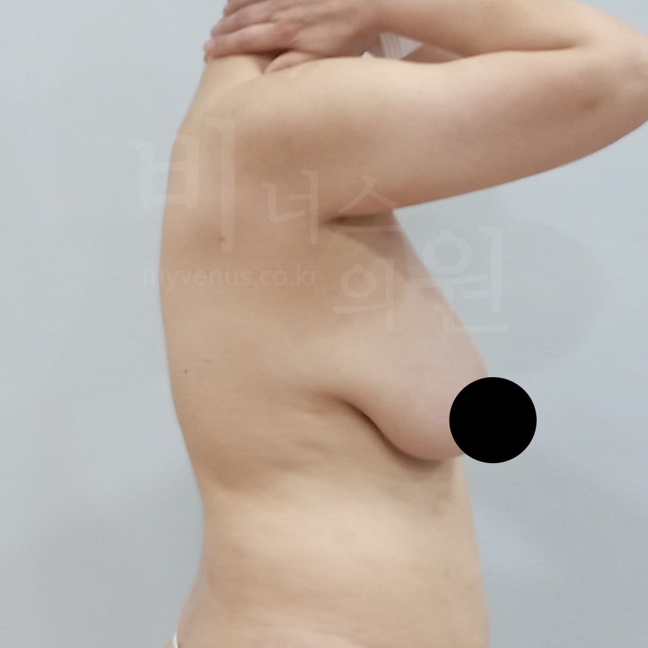 가슴 지방흡입 수술 전 측면