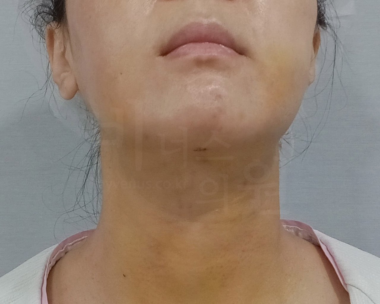 턱지방흡입 수술 후 정면 비너스의원
