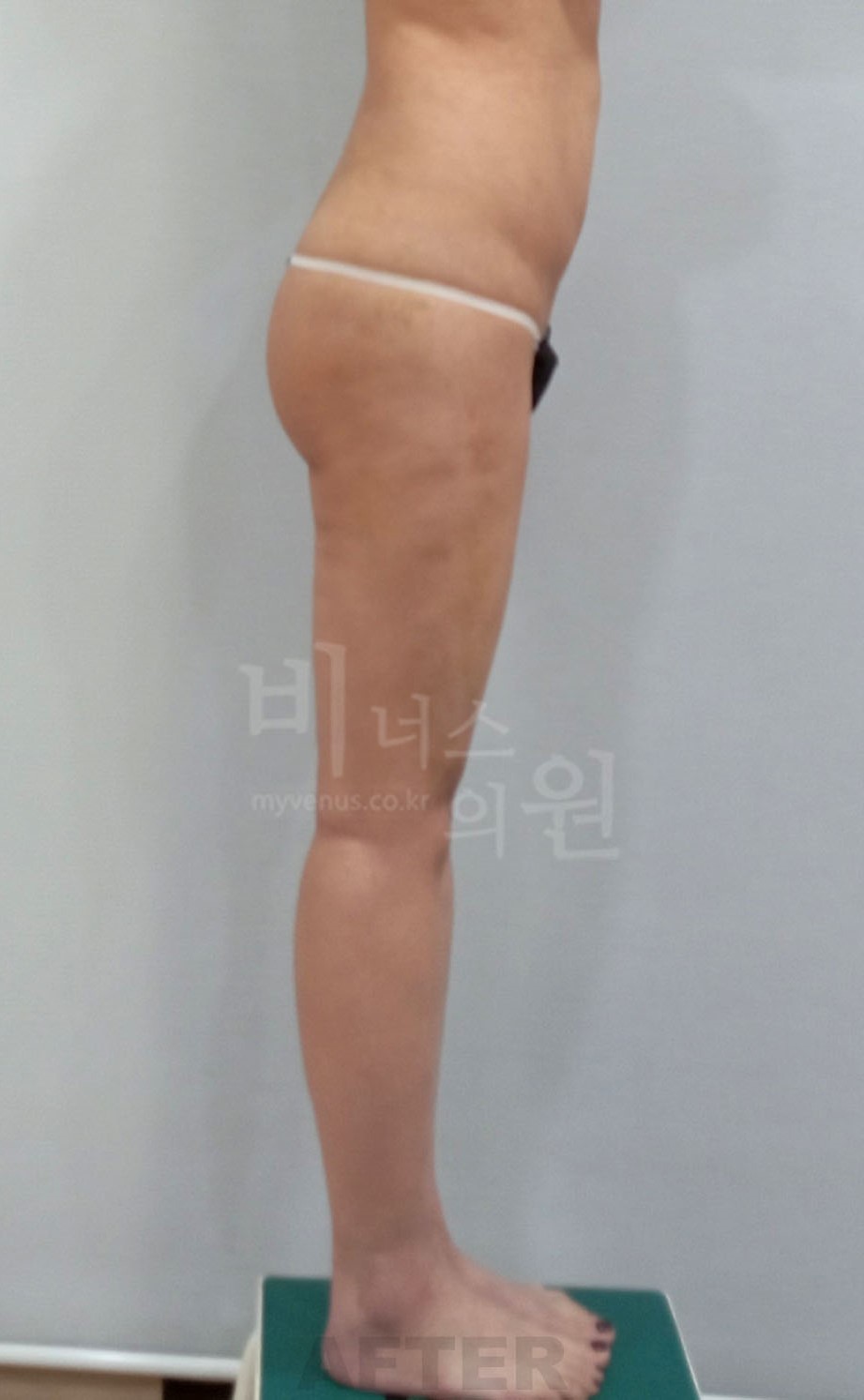 엉덩이축소 지방흡입 수술 후 반대측면 비너스의원