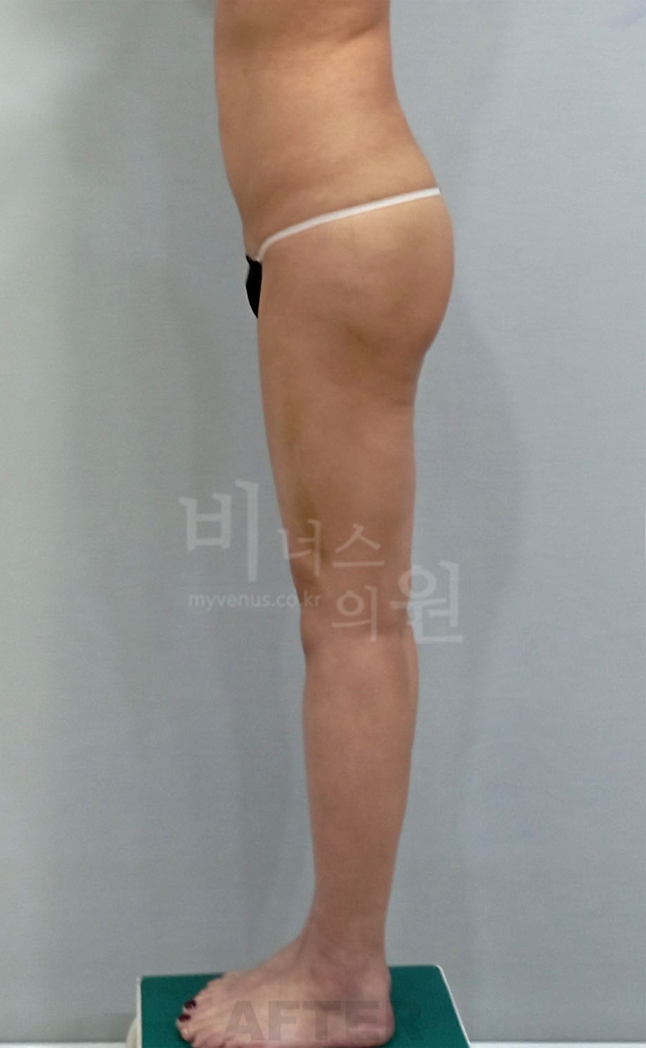 엉덩이축소 지방흡입 수술 후 측면 비너스의원