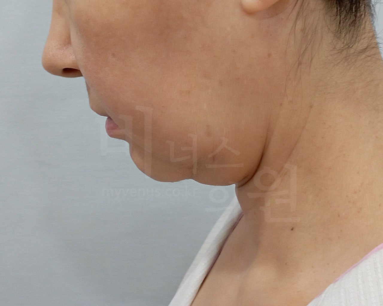 턱지방흡입 수술 전 우측면 비너스의원