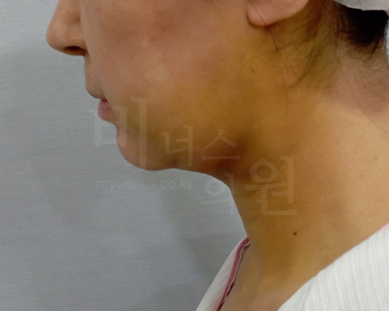 턱지방흡입 수술 후 우측면 비너스의원