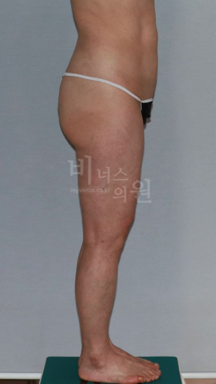 엉덩이 볼륨업 지방흡입 수술 전 후좌사면 비너스의원