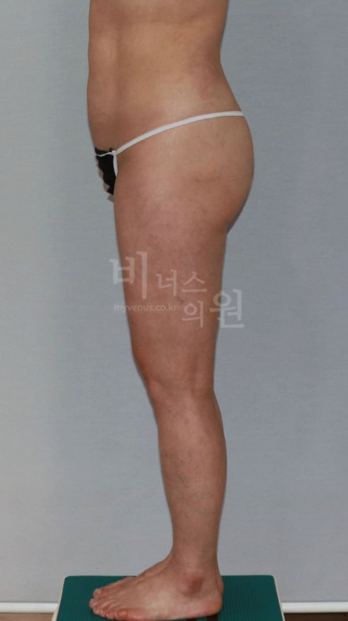 엉덩이 볼륨업 지방흡입 수술 후 우측면 비너스의원