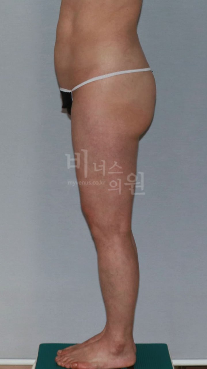 엉덩이 볼륨업 지방흡입 수술 전 우측면 비너스의원