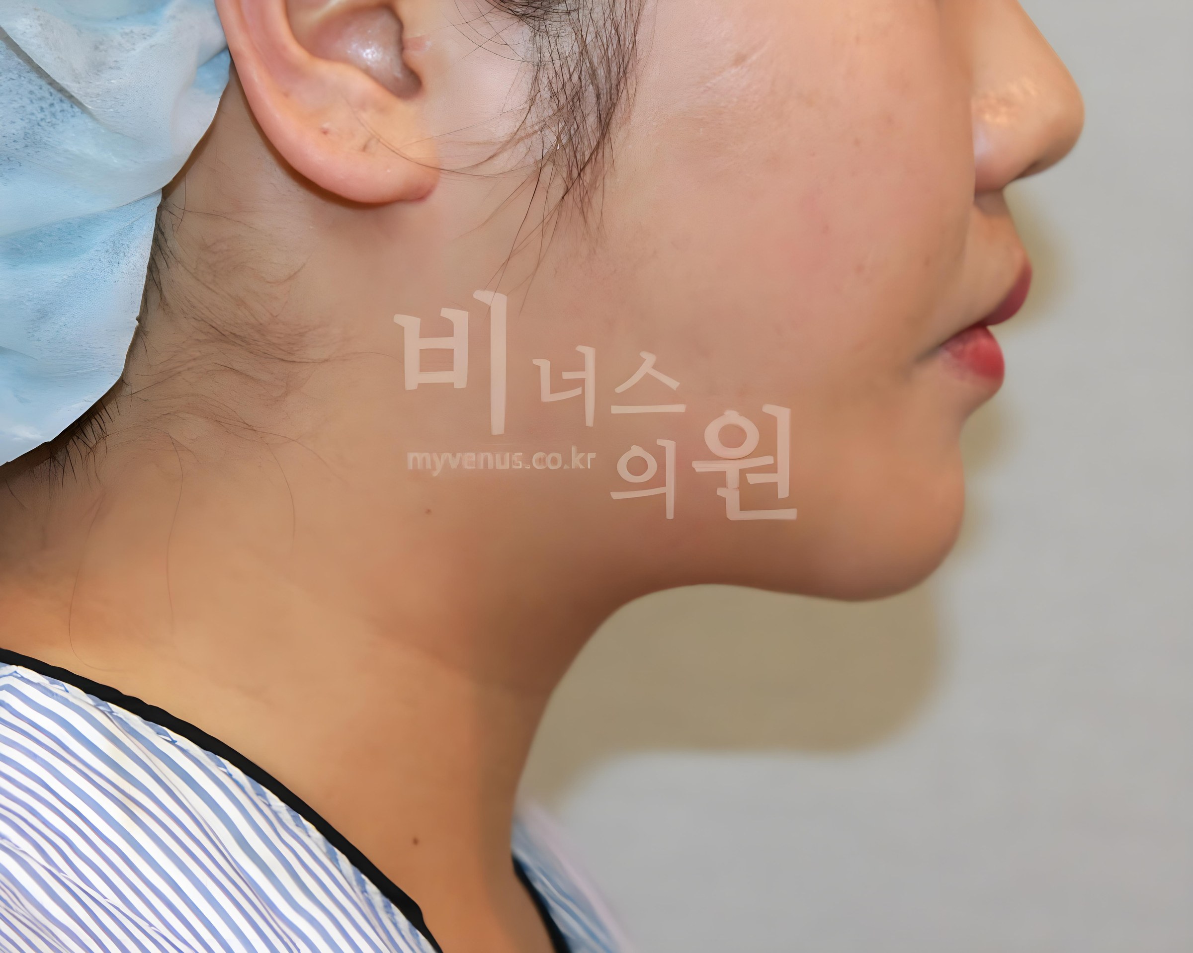 턱지방흡입 후 옆면 비너스의원 부천 턱선 개선