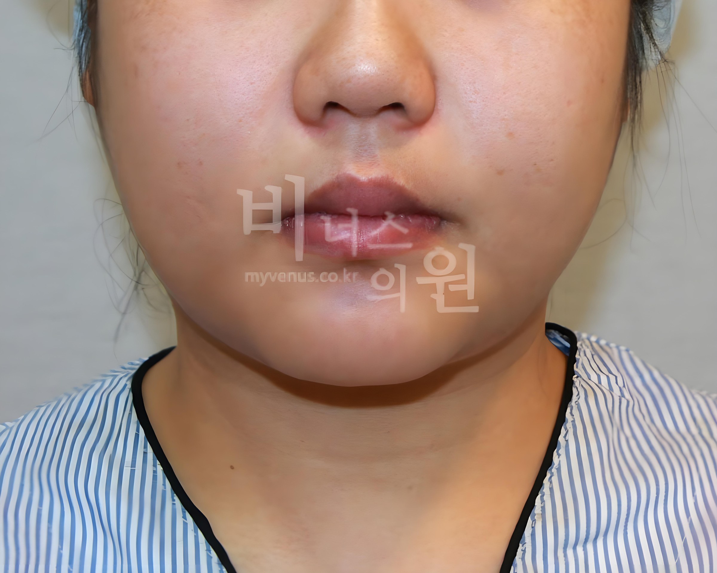 턱지방흡입 전 정면 비너스의원 부천 이중턱