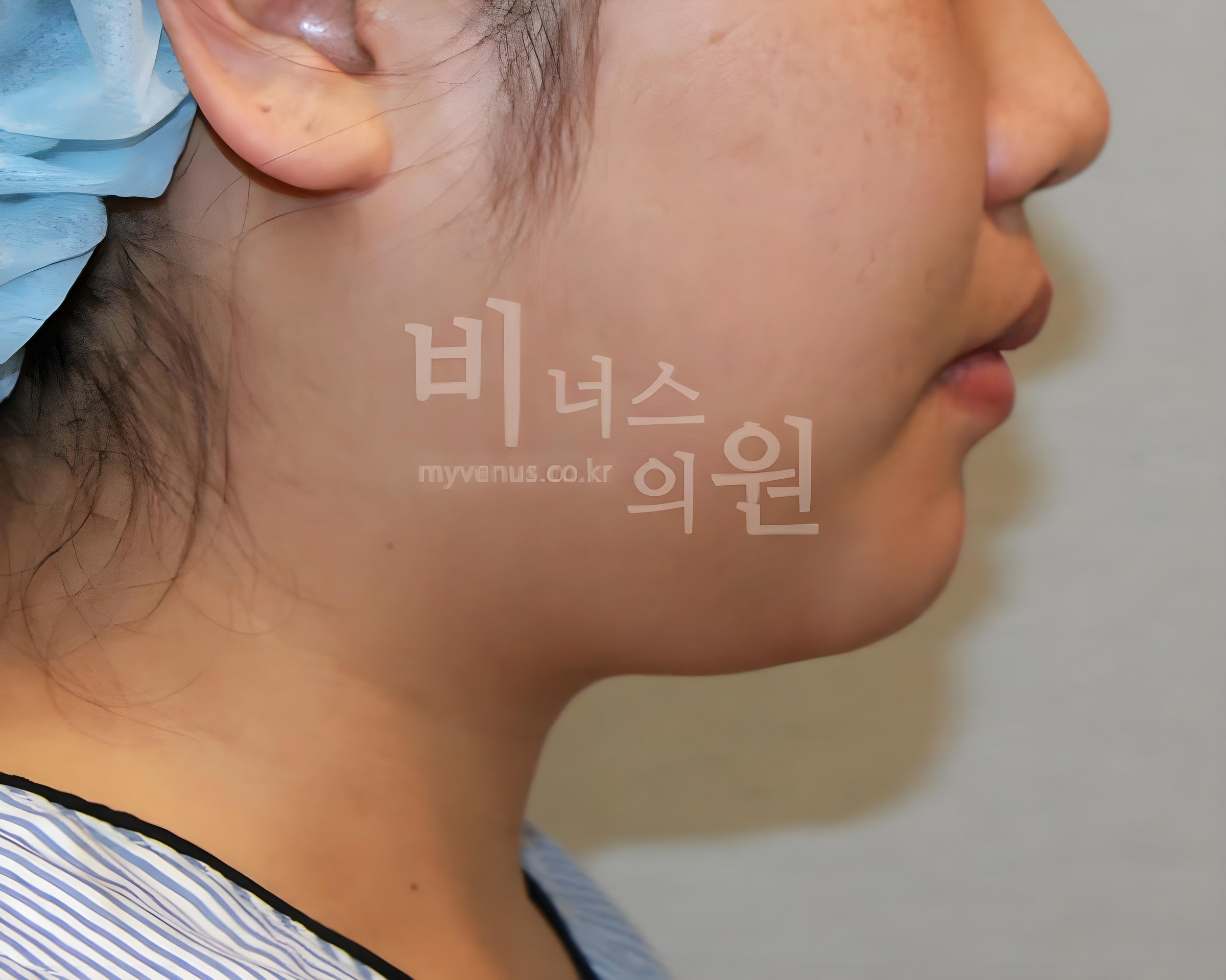 턱지방흡입 전 옆면 비너스의원 부천
