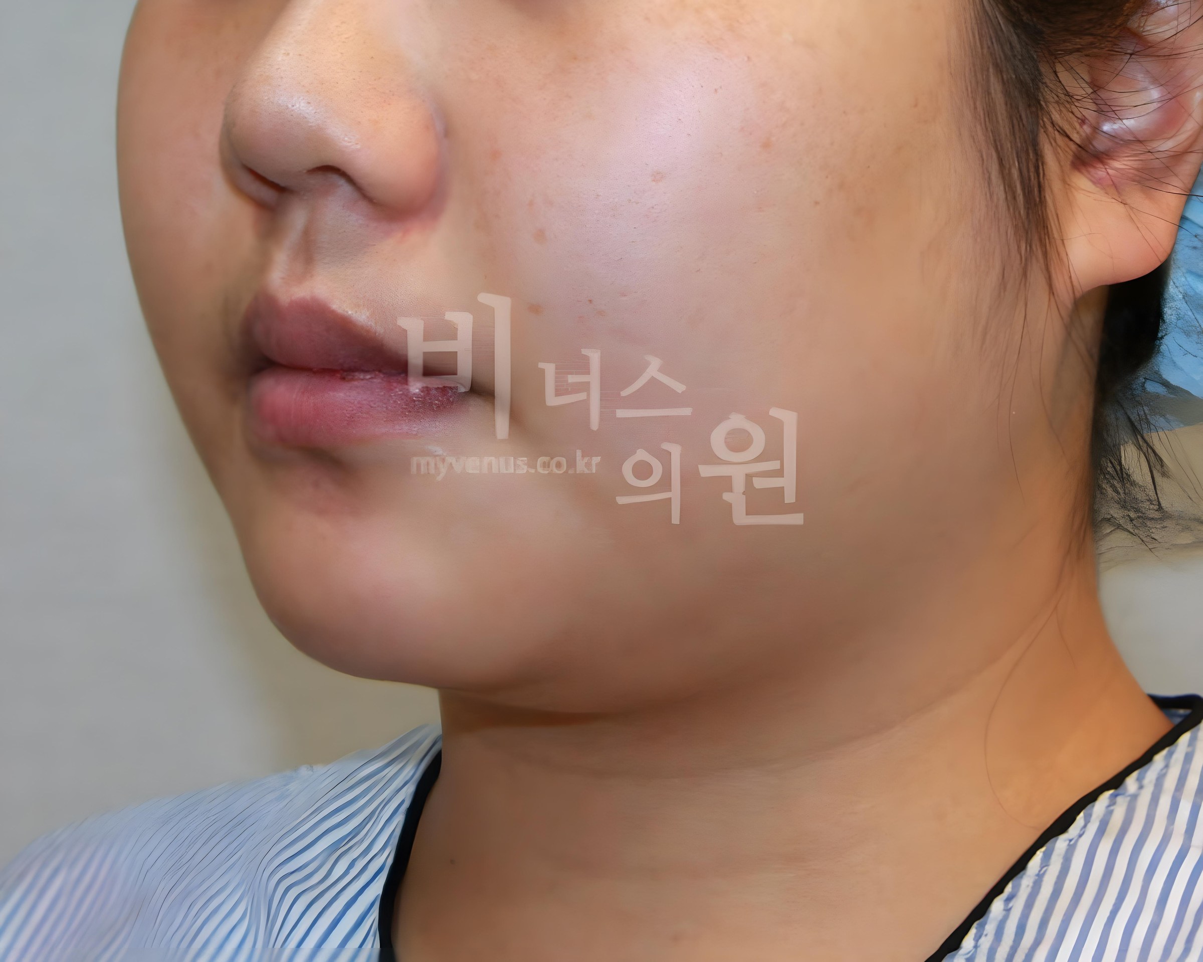 턱지방흡입 전 측면 비너스의원 부천
