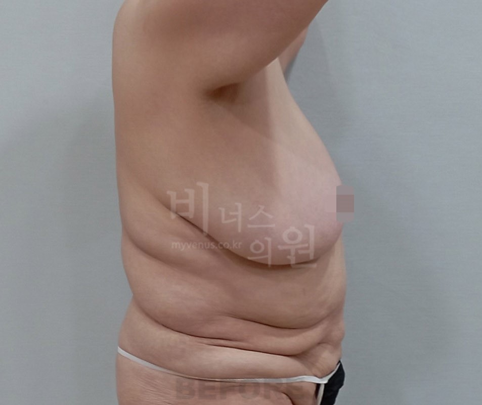 거대유방축소술_4.JPG