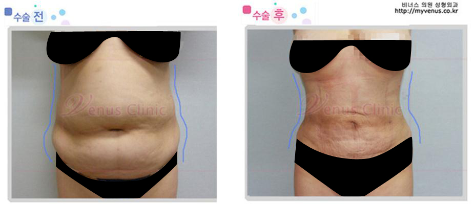 대용량복부지방흡입.jpg