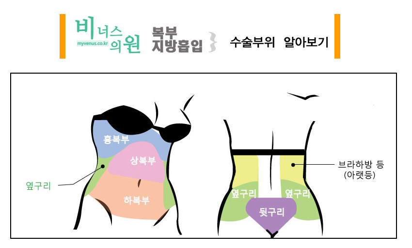 복부지방흡입.jpg